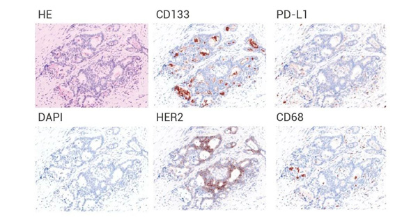 Fig 3. monochromatic IHC (top) and multichromatic mIHC (bottom) validation of cancer tissue.