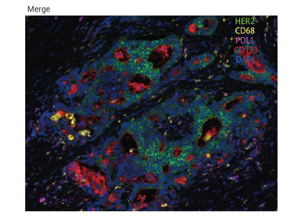 Fig 3. monochromatic IHC (top) and multichromatic mIHC (bottom) validation of cancer tissue.
